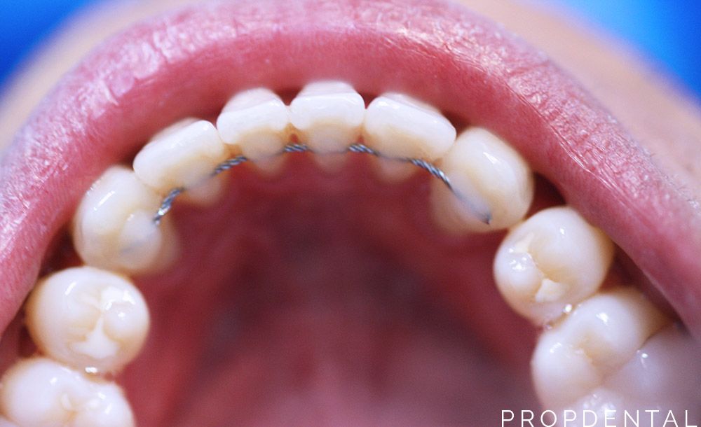 retenedor de ortodoncia fijo