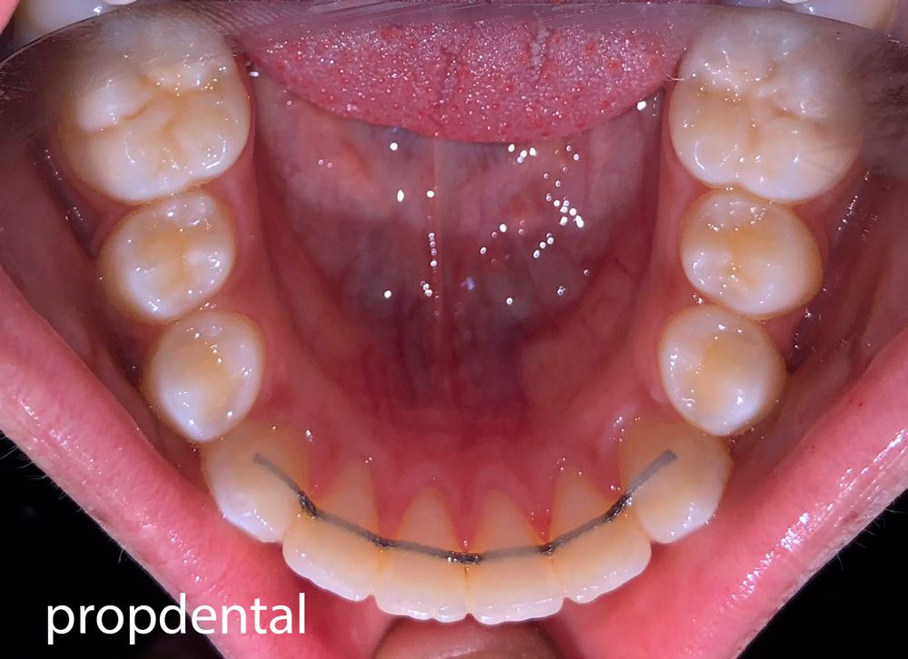 retenedores dentales de ortodoncia