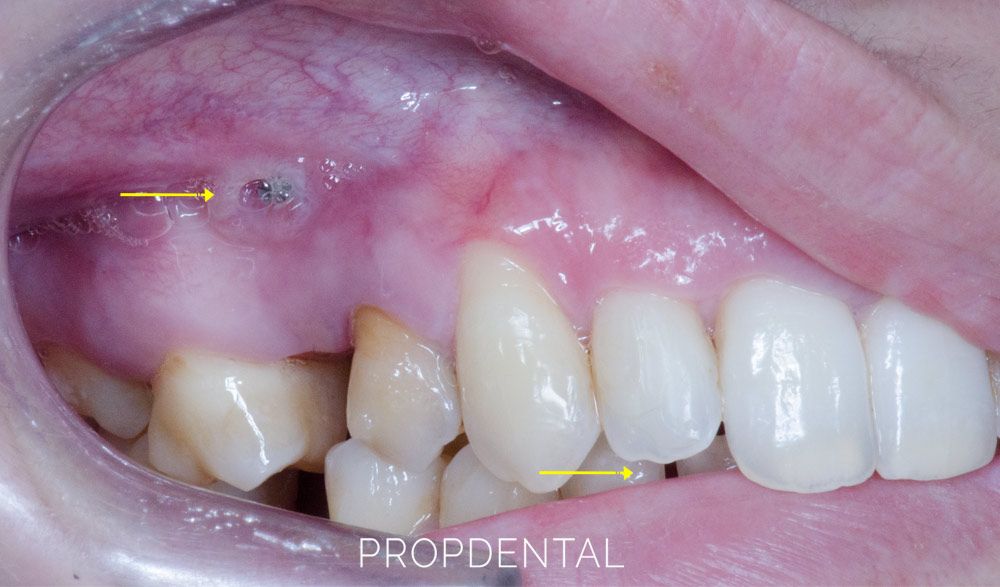 microtornillos en ortodoncia