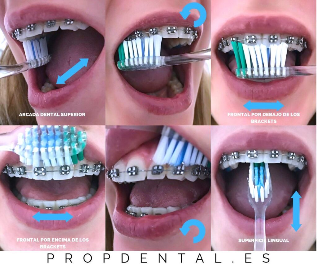 cepillado dental con brackets