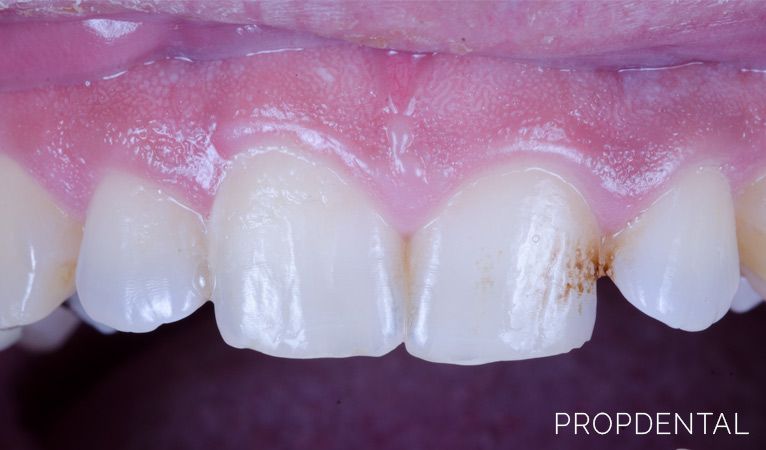 3 tipos de manchas dentales y cómo pueden tratarse con odontología estética