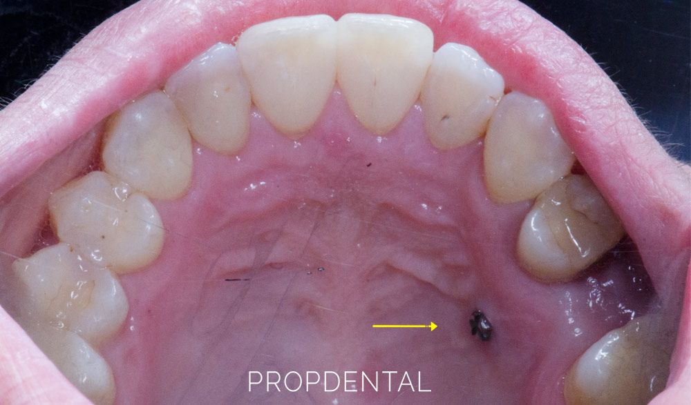 microimplantes de ortodoncia