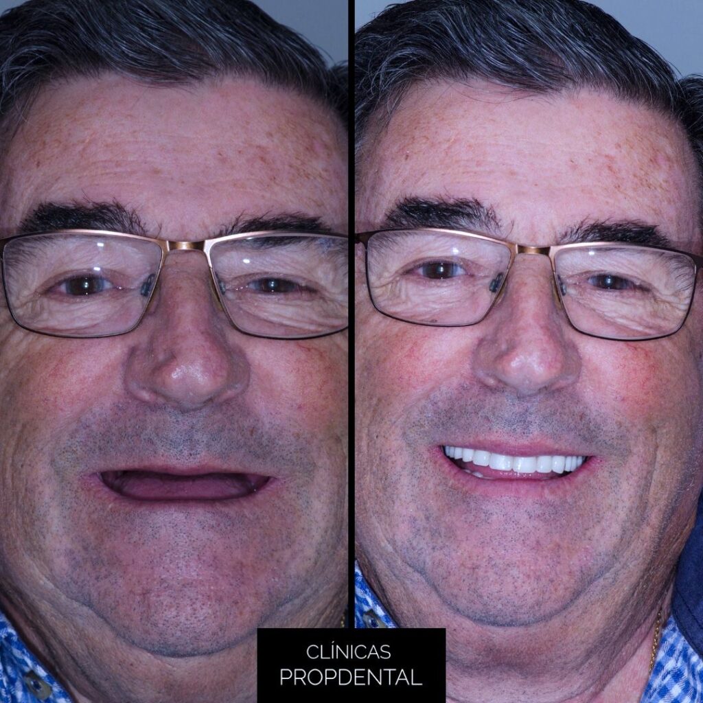 sobredentadura sobre implantes dentales en Madrid