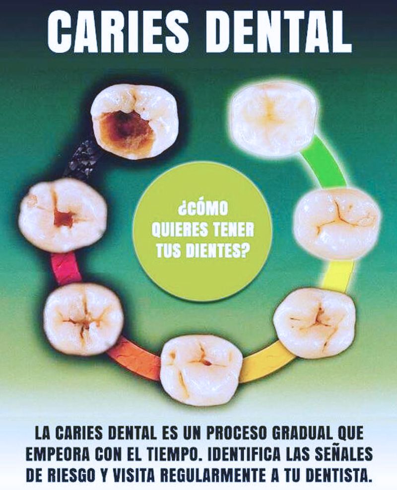 Tratar la caries dental en Madrid y Barcelona