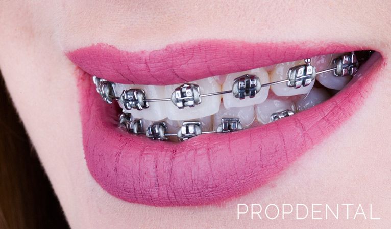 Métodos para alinear tus dientes