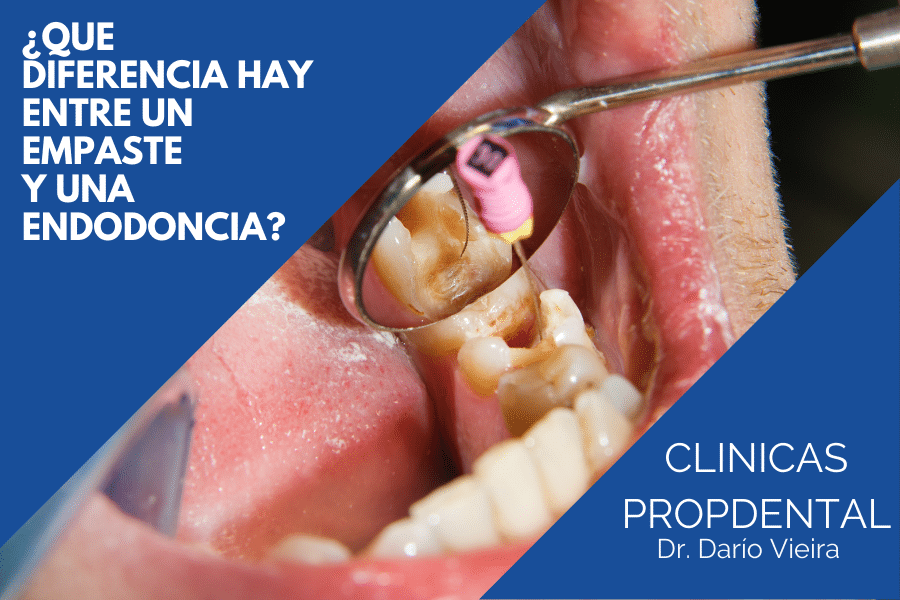 ¿Cómo sé si necesito una endodoncia?