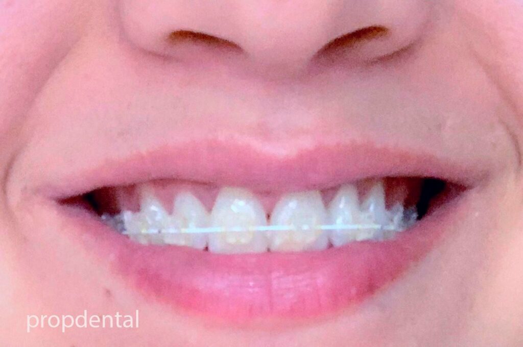 brackets dentales en Madrid y Barcelona