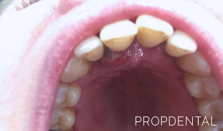 si Modales Búsqueda Tipos de infecciones dentales ¿Como tratar una infección de boca?