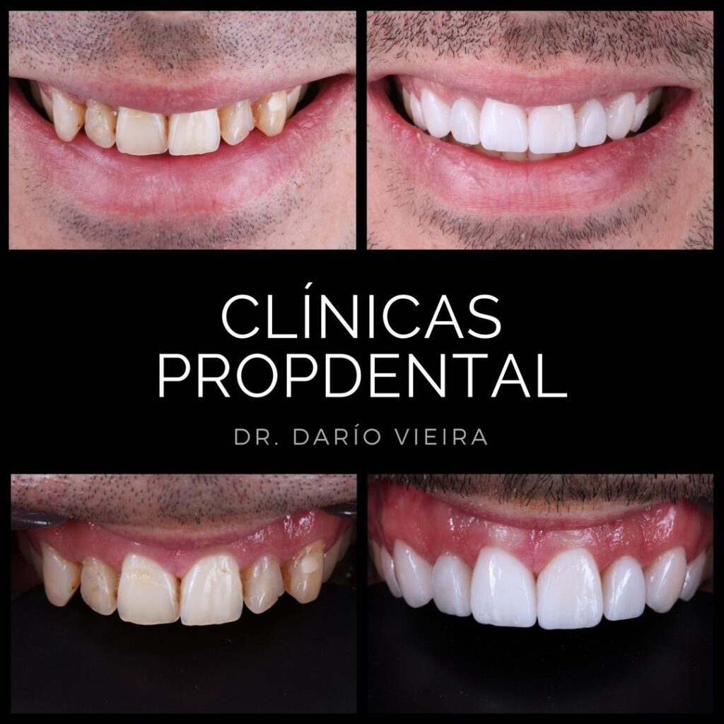 Carillas dentales: ¿cuáles son las ventajas y desventajas? – Estudi Dental  Barcelona