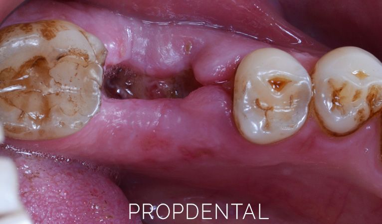 infecciones dentales tras una extracción
