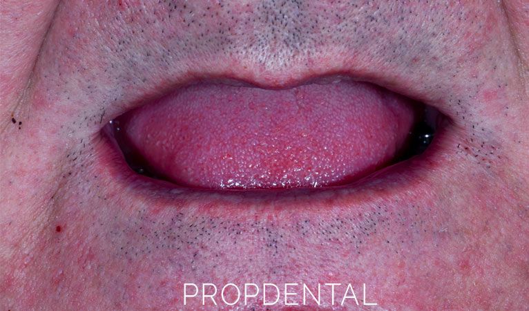 consecuencias de la falta de dientes
