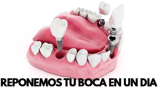 poner toda la boca con implantes de carga inmediata