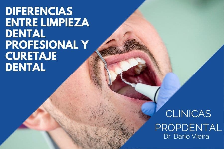 diferencias entre-la-limpieza dental y el raspado radicular
