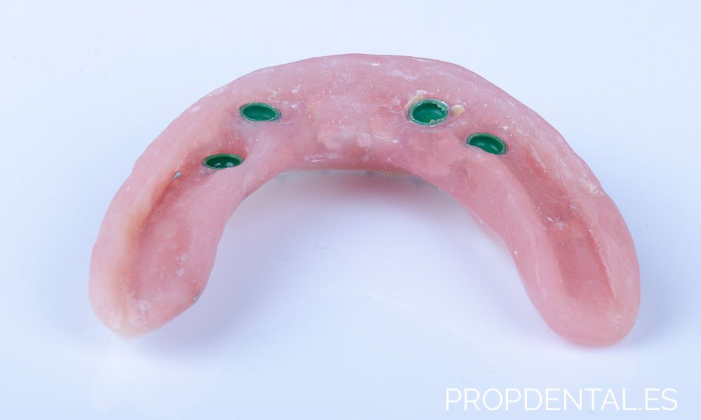 sobredentadura sobre implantes dentales