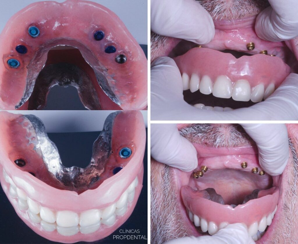 Colocación de sobre dentadura en boca