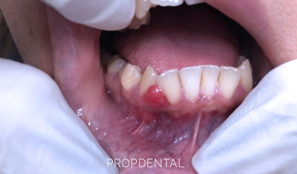 tratamiento-del-granuloma-piogenico-dental