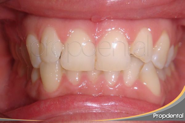 dientes mal alineados antes de empezar el tratamiento