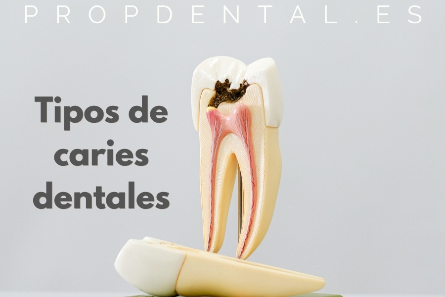 tipos de caries dentales