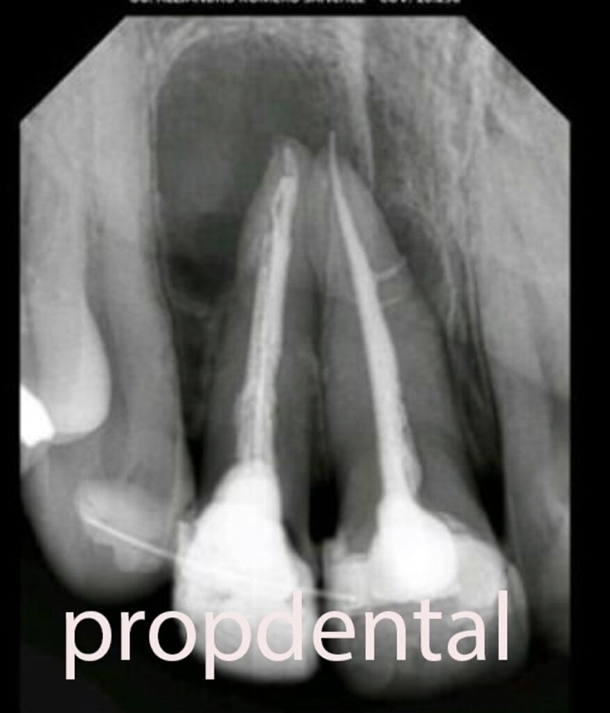 radiografía de una infección dental donde se ve una imagen radiotrasparente alrededor de las raíces de los incisivos superiores