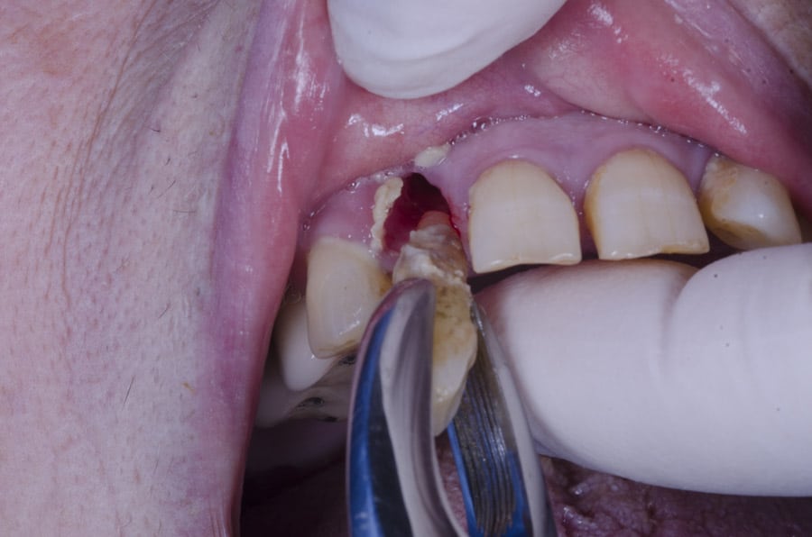 contraindicaciones de las extracción dental