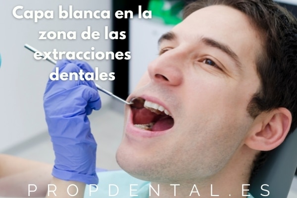 Capa blanca en la zona de las extracciones dentales