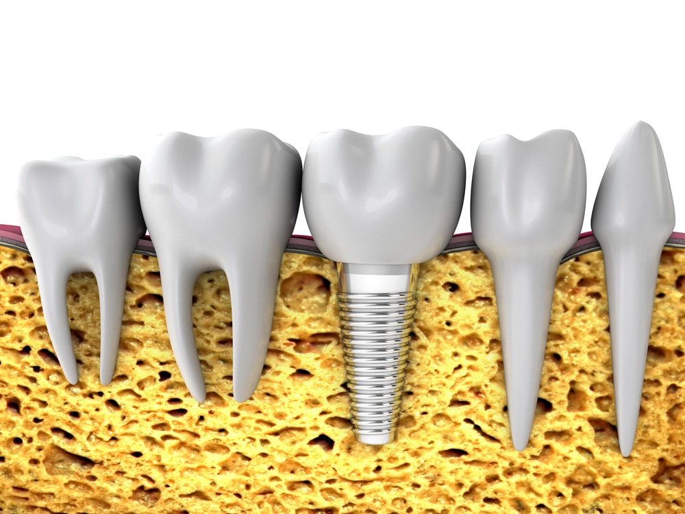Cuanto dura un implante dental