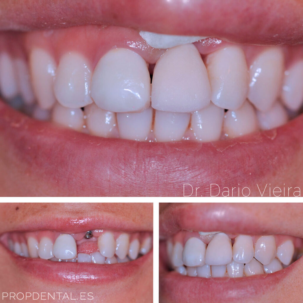 Diente postizo provisional para implante dental