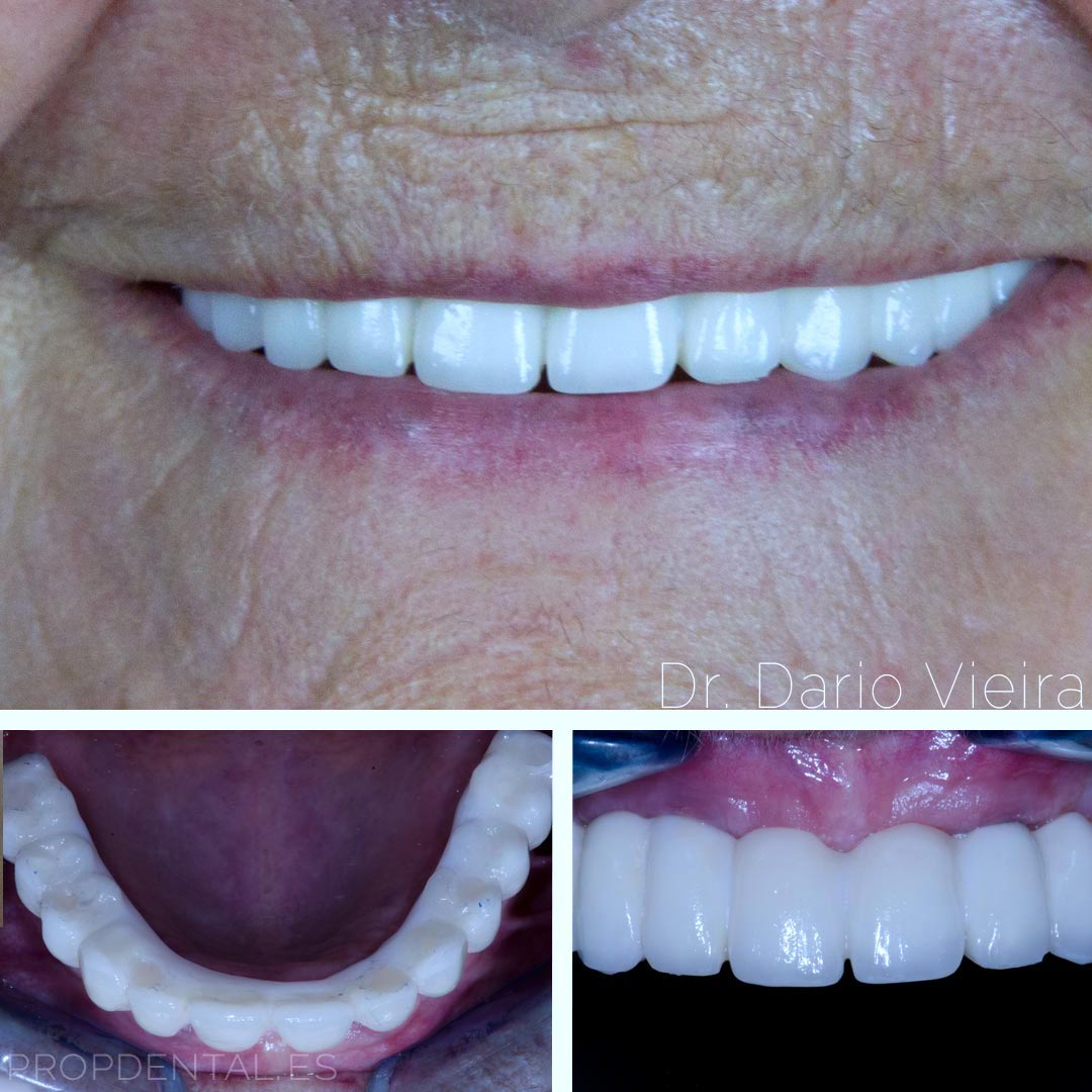 Implantes dentales en toda la boca