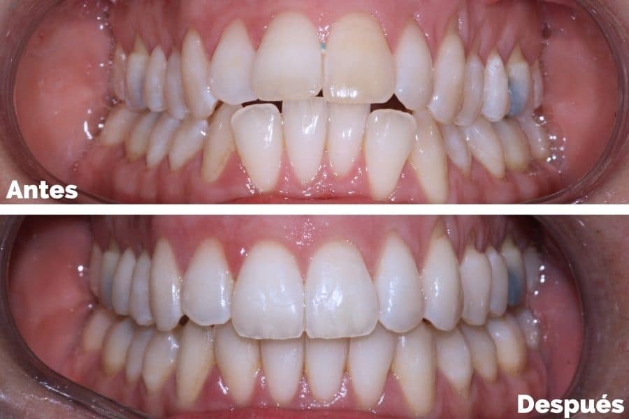 Ceder el paso Respecto a digestión Cómo arreglar los dientes Inclinados hacia dentro o afuera?