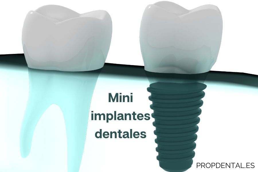 mini implantes dentales