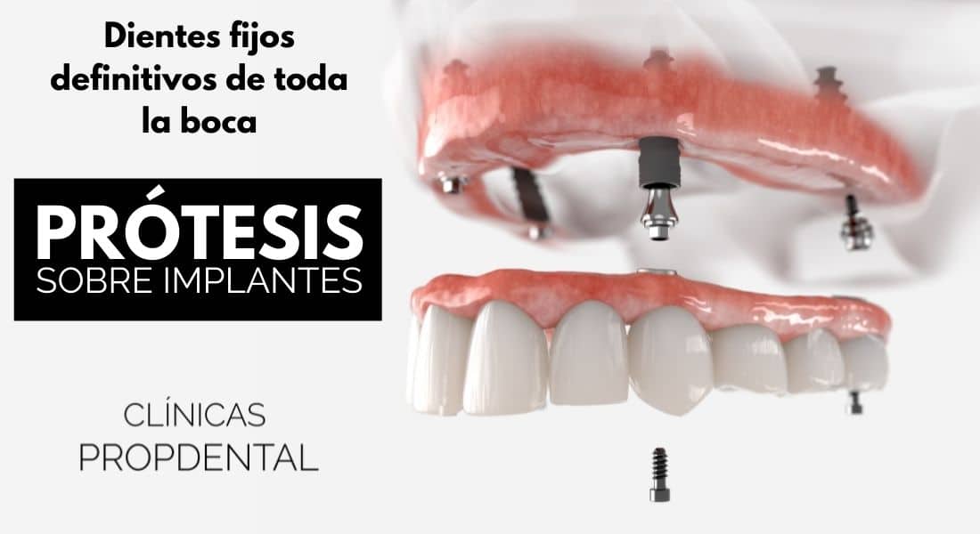 Tipos de prótesis sobre implantes dentales en Propdental