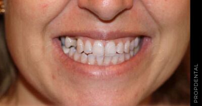 ¿Cómo se pone un diente postizo provisional?