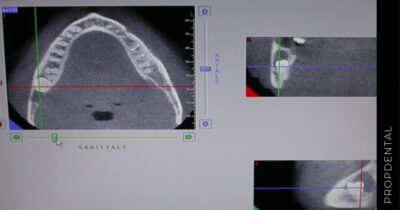 Tomografia computadorizada para implantes dentales