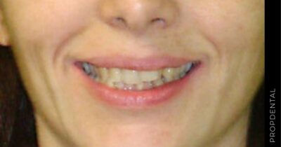 Ortodoncia invisalign G4 para dientes montados
