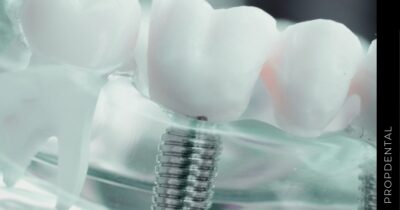 Prótesis sobre implantes dentales