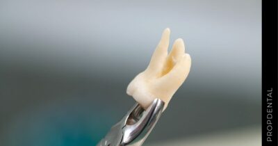 Cuidados después de una extracción dental