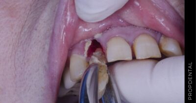 Contraindicaciones de las extracciones dentales
