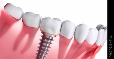 Dolor en implantes dentales