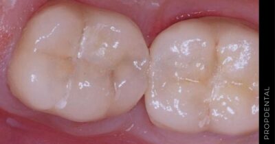 Proceso de colocación de una corona dental