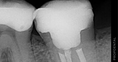 Ventajas de la reendodoncia