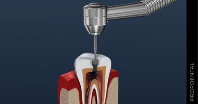 Preguntas frecuentes de endodoncia