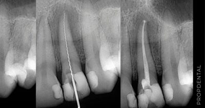 Lesión periodontal primaria con afectación endodontica secundaria