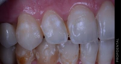 Erosión dental
