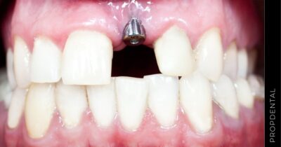 Falta de hueso para implantes dentales