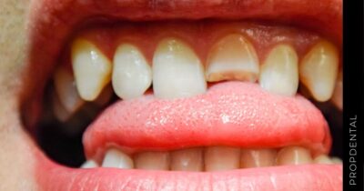 Síntomas de un diente fracturado