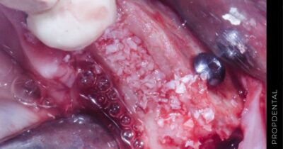 Injerto de hueso dental para implante