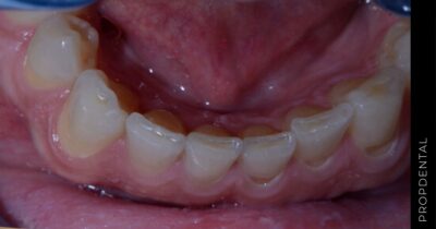 Rechinamiento de los dientes