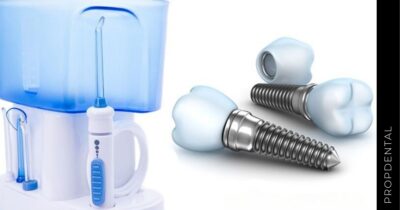 Limpieza y cuidados para tus implantes dentales