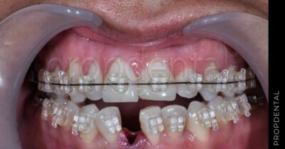 Ortodoncia con extracciones
