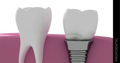 Postoperatorio implantes dentales y tiempo de recuperación